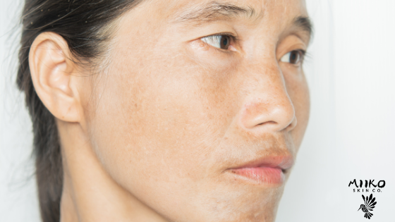 What is Hyperpigmentation?